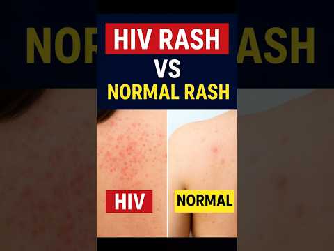 HIV Rash Vs Normal Rash How To Identify The Difference