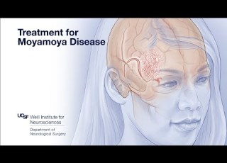  Treatment For Moyamoya Disease UCSF Comprehensive Stroke Center