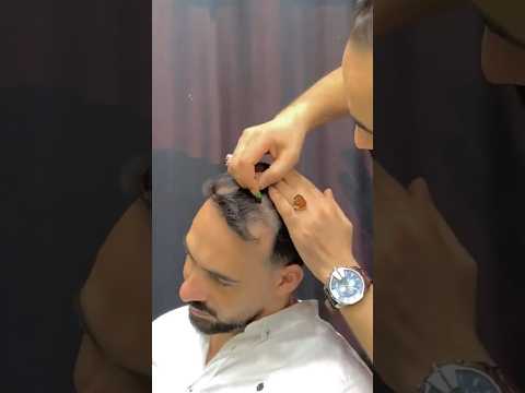 How To Get Rid Of Hereditary Baldness Please Appreciate My Effort And Support The Video How To Get Rid Of Hereditary Baldness Please Appreciate My Effort And Support The Video