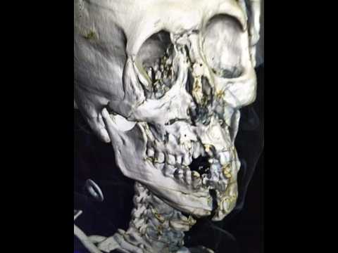 اخطر إصابة في كرة القدم بكاس العالم 2022