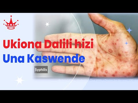 UJUE UGONJWA WA KASWENDE NA JINSI UNAVYOAMBUKIZWA UKIONA DALILI HIZI UJUE UNA MAAMBUKIZI TAYARI UJUE UGONJWA WA KASWENDE NA JINSI UNAVYOAMBUKIZWA UKIONA DALILI HIZI UJUE UNA MAAMBUKIZI TAYARI
