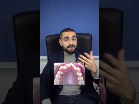 خايف من خلع الاسنان مع التقويم