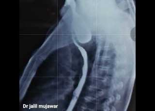 Oesophageal Diveruculum Zenkers Diverticulum Dr Jalil Mujawar