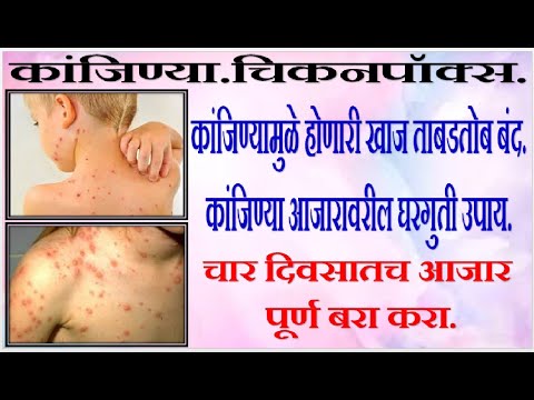 आय र व द क ज ण य च कनप क स व र फ ड य घरग त उप य KANJINYA CHICKENPOX