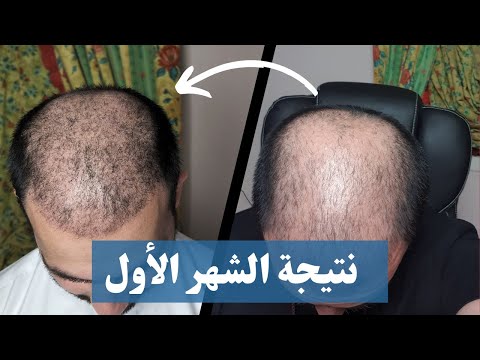 نتيجة زراعة الشعر الشهر الأول
