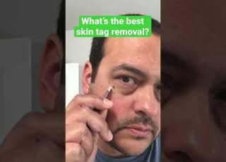 Best Skin Tag Removal At Home Shorts