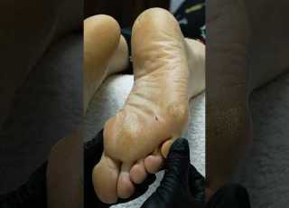  Incredible Severe Foot Callus Makeover