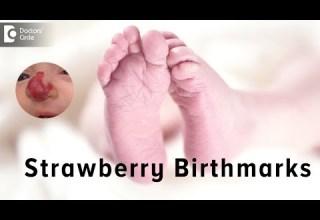 Strawberry Birthmarks Dr Priya J Talageri