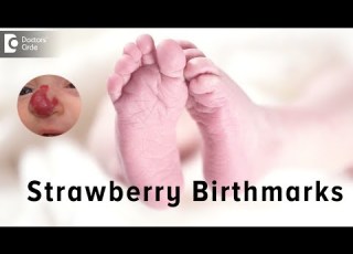 Strawberry Birthmarks Dr Priya J Talageri