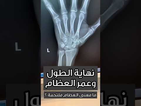 نهاية الطول وعمر العظام د خالد الجناعي