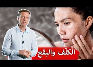  الكلف بقع الجلد الداكنة ٣ أسباب ونصائح