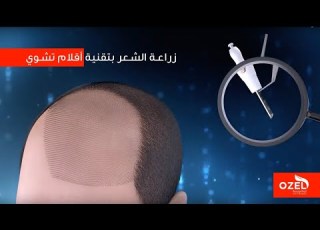  كيف تتم عملية زراعة الشعر بتقنية أقلام تشوي DHI