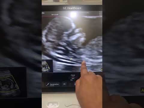 Level 1 Scan Or NT Nb Scan