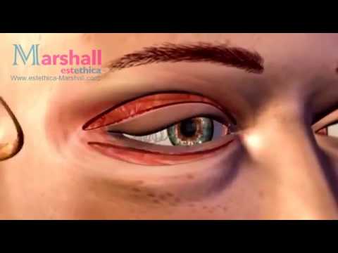 عملية شد الجفون السفلى والعليا