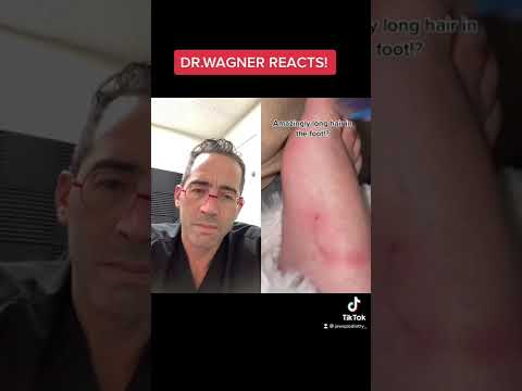 LONGEST INGROWN HAIR Shorts Ingrown Ingrownhair