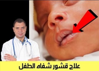 علاج قشور شفاه الطفل
