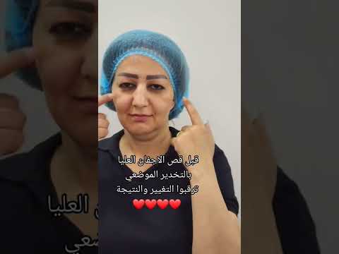 قبل قص الاجفان العليا بالتخدير الموضعي مجمع النور الطبي قبل قص الاجفان العليا بالتخدير الموضعي مجمع النور الطبي