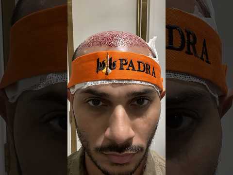 نتيجة زراعتي الشعر بعد 6 أشهر تجربتي مع زراعة الشعر نتيجة زراعتي الشعر بعد 6 أشهر تجربتي مع زراعة الشعر