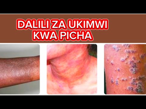Dalili Za UKIMWI Kwa Picha Tambua Mapema Kabla Haijawa Mbaya