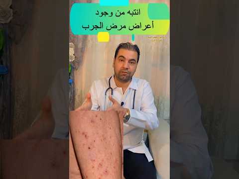 احذر من وجود أعراض مرض الجرب