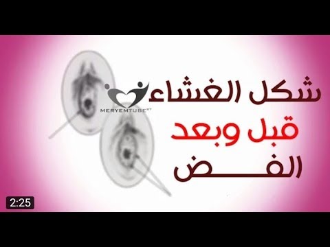 الفرق بين الغشاء السليم والغير سليم