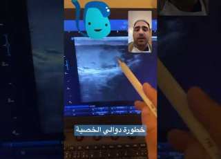 خطورة دوالي الخصية عقم الرجال دوالي الخصية