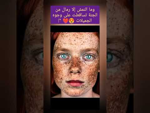 وما النمش إلا رمال من الجنة تساقطت على وجوه الجميلات وما النمش إلا رمال من الجنة تساقطت على وجوه الجميلات