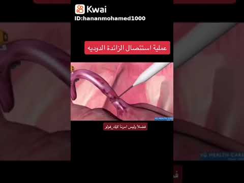 عملية الزائده الدوديه