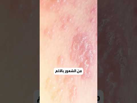 أعراض وأسباب الحزام الناري