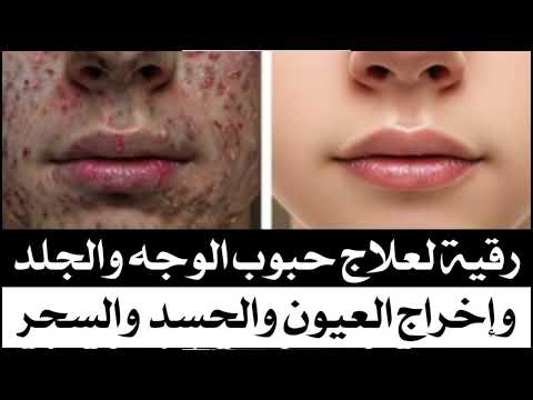 رقية بدلناهم جلودا غيرها لاخراج الحبوب والنمش والحروق والسواد من الوجه والعيون والجلد رقية الجلد