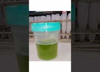  Does The Change In Urine Color To Green Have Serious Implications