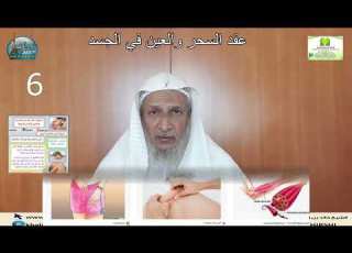  عقد السحر والعين في الجسد 6 الراقي والطبيب والعقد