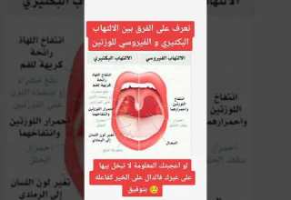 الفرق بين الإلتهاب البكتيري والفيروسي للوزتين
