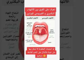 الفرق بين الإلتهاب البكتيري والفيروسي للوزتين