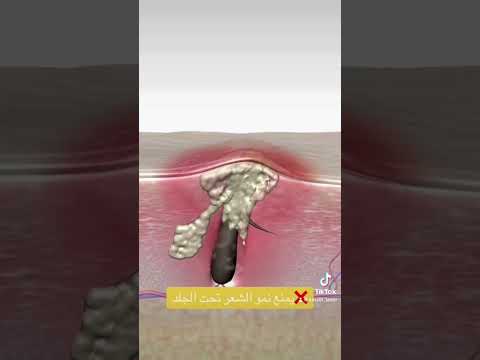 يمنع نمو الشعر تحت الجلد Foryoupage Shaving Kinseibeautylaser Foryou E3 Foryou يمنع نمو الشعر تحت الجلد Foryoupage Shaving Kinseibeautylaser Foryou E3 Foryou