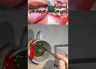  تخلصي من التهابات وتقرحات الفم نهائي ا بوصفة مجربة