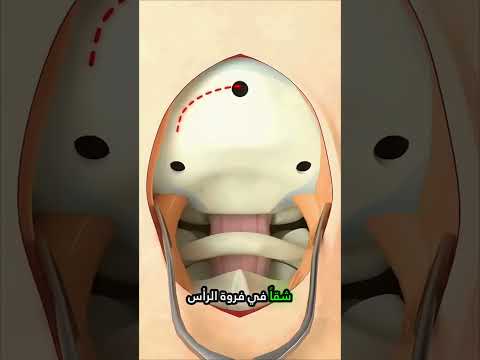 ما الذي يحدث داخل الرأس أثناء جراحة الدماغ