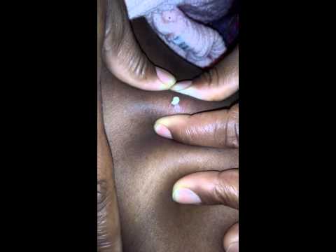 Best Cyst Popping Ever Pt 1