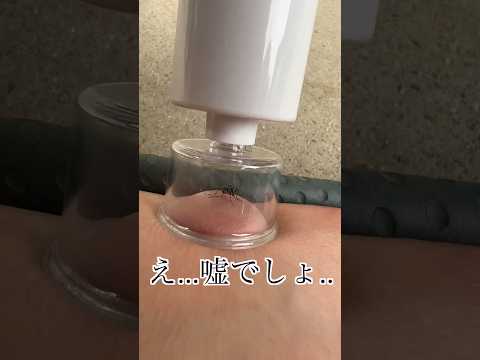 血を吸い続けている蚊に毒抜き機で蚊も一緒に吸い出してみたら