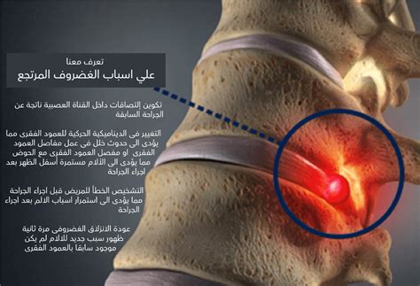 أجب عن السؤال عن أسباب الغضروف الذي يغطي أطراف العظام في المفاصل