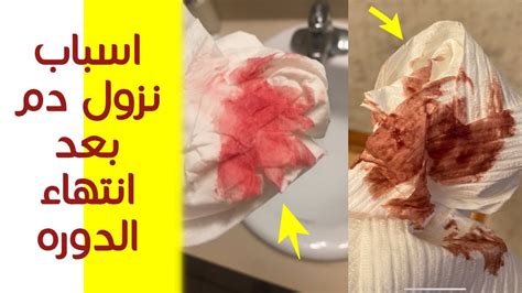 أسباب أخرى للنزيف الأحمر بعد انتهاء دورتك الشهرية أسباب أخرى للنزيف الأحمر بعد انتهاء دورتك الشهرية