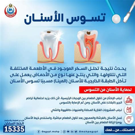 أسباب تسوس الأسنان بالرغم من التنظيف