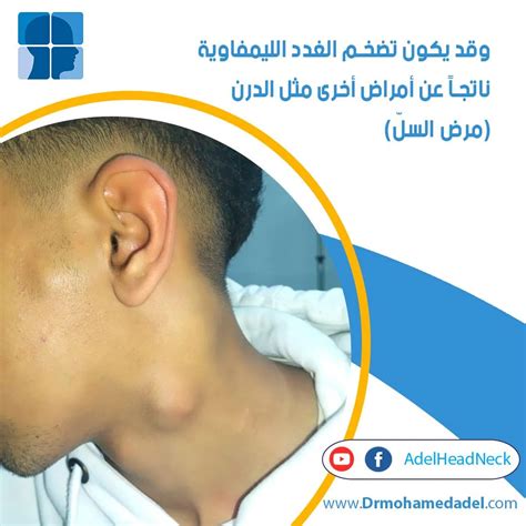 أعراض التهاب العقد اللمفية (أعراض تضخم الغدد الليمفاوية)