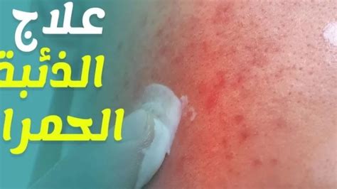 أعشاب تستخدم في علاج الذئبة الحمامية