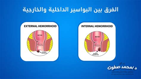 أفضل أنواع التحاميل المخدرة لألم البواسير الداخلية والخارجية أفضل أنواع التحاميل المخدرة لألم البواسير الداخلية والخارجية