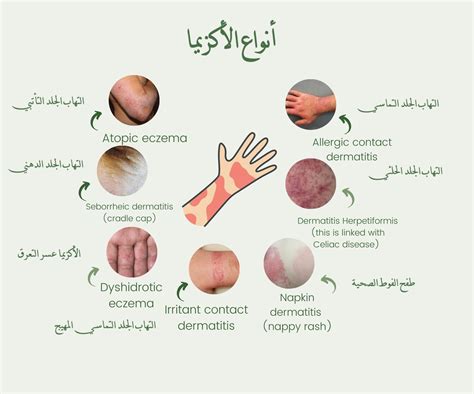 أنواع الأكزيما حسب الأكاديمية الأوروبية