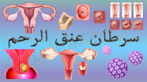 إذا كان السبب هو تكوين خلايا سرطانية في بطانة الرحم