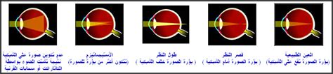 إذا كان بإمكانك رؤية الأشياء القريبة بوضوح فقط، فأنت تعاني من مد البصر، سواء أكان ذلك صحيحًا أم خطأ