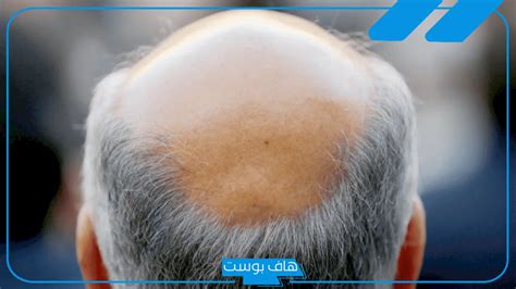 إيضاح تفسير حلم الصلع في مقدمة الرأس لامرأة متزوجة