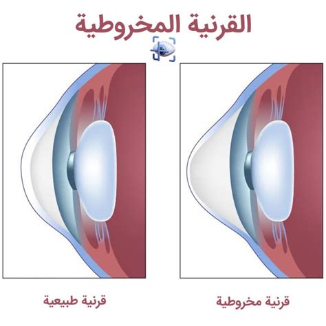 اشرح سبب احتواء الطبقة القرنية على بلاستيدات خضراء أكثر من طبقة الإسفنج